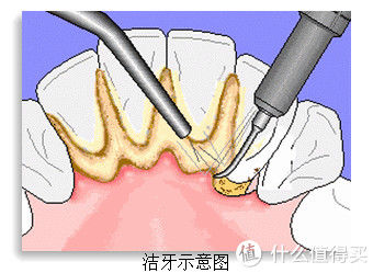 便头脑一热,交钱,洗牙其实就是把牙石用超声波振掉,牙结石是平时吃的