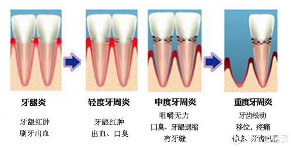 牙周炎的产生与牙龈炎类似,也是因为细菌聚集,健康的牙龈组织与牙齿的