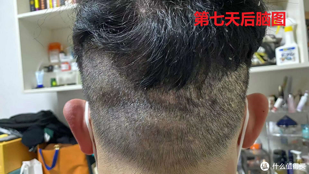 35岁大叔的植发经历植发后第一个月