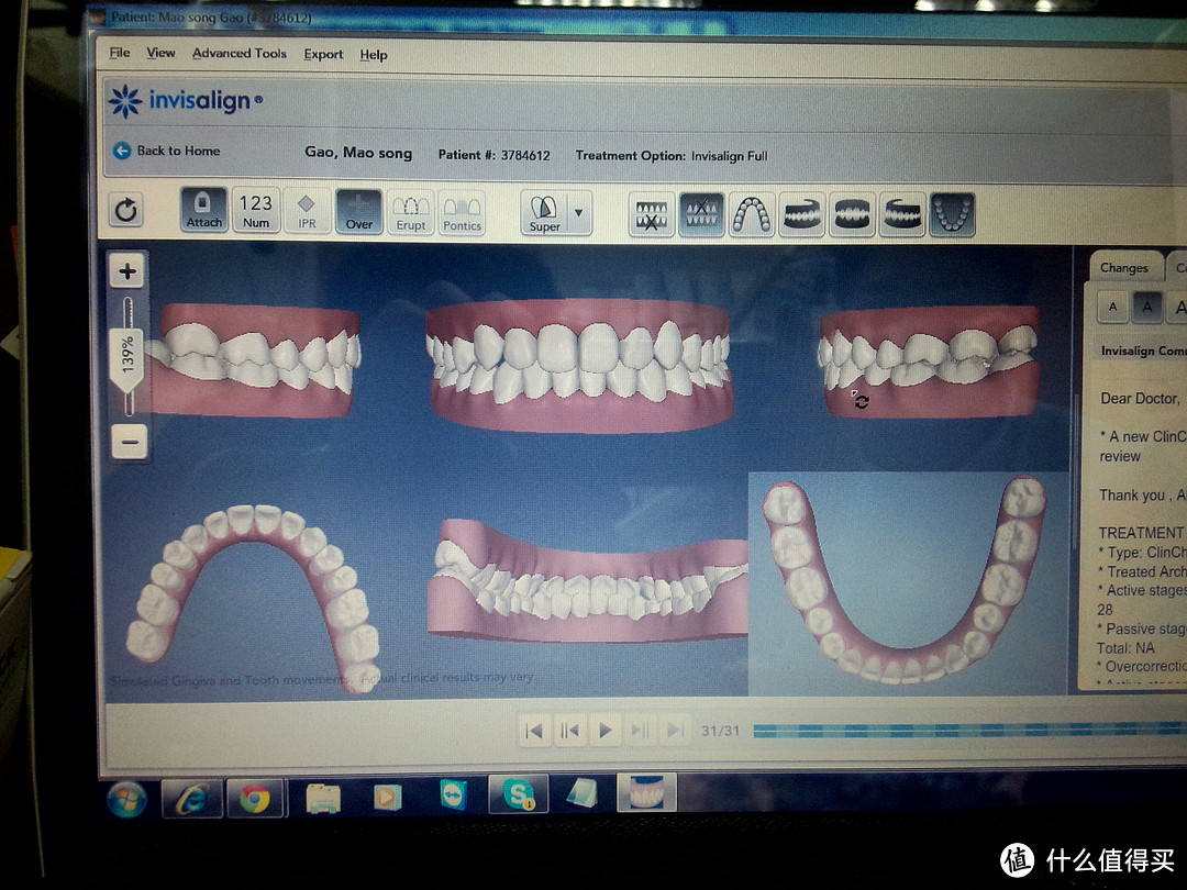 使用隐形牙套的牙齿矫正经历