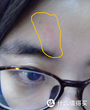 痘后综合征患者的自救之路:跟困扰油皮的脂溢性皮炎说再见