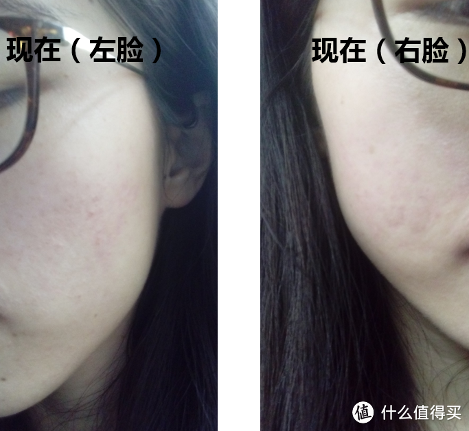 痘后综合征患者的自救之路:跟困扰油皮的脂溢性皮炎说再见