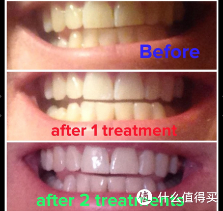 Dr Song Home Professional Teeth Whitening Kit牙齿冷光美白套装