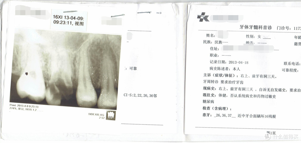 我的种植牙经历分享 | 种牙好还是镶牙好_种植