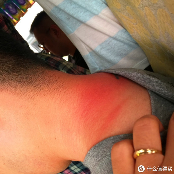 在牛岛被晒伤的脖子