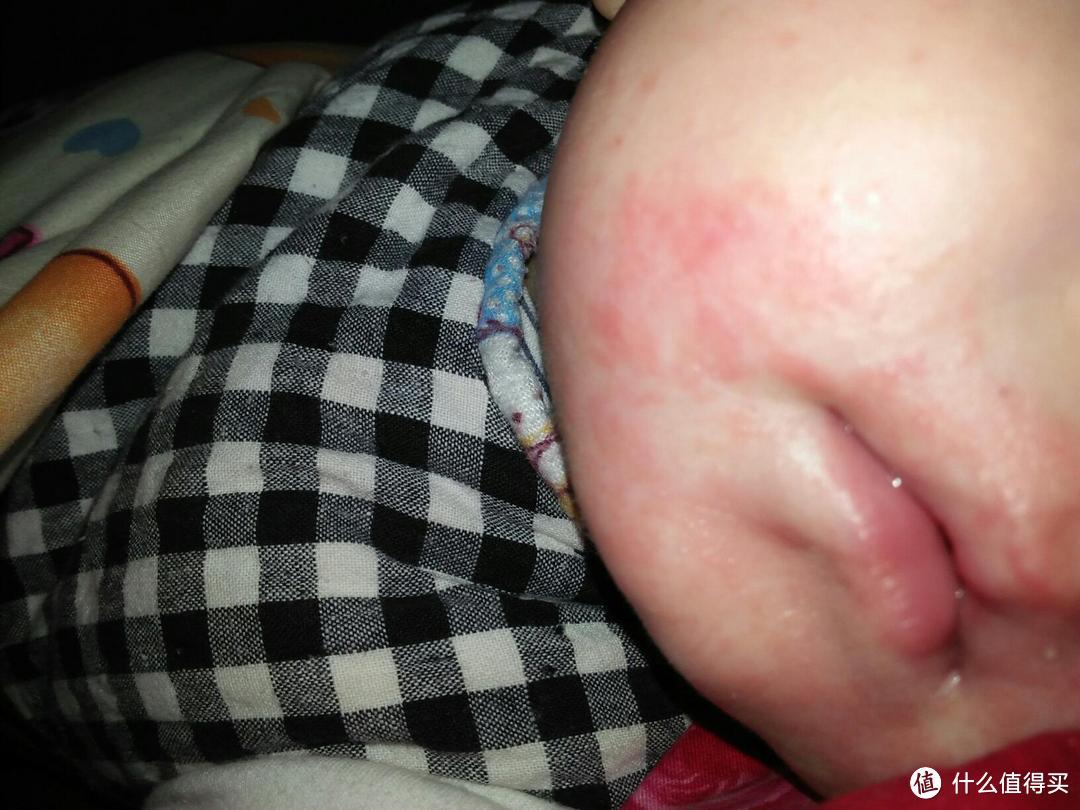 婴儿湿疹（婴儿期特应性皮炎）