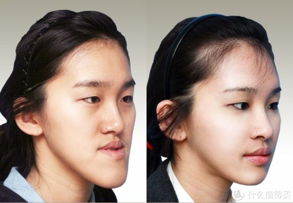 上面这菇凉肯定是直接手术截断下颚骨,外加上颚骨外扩,光靠常规戴牙套