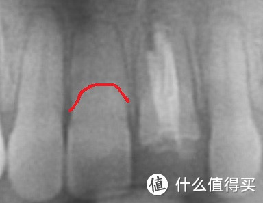 浅谈成年以后做正畸的利与弊——痛苦的正畸史