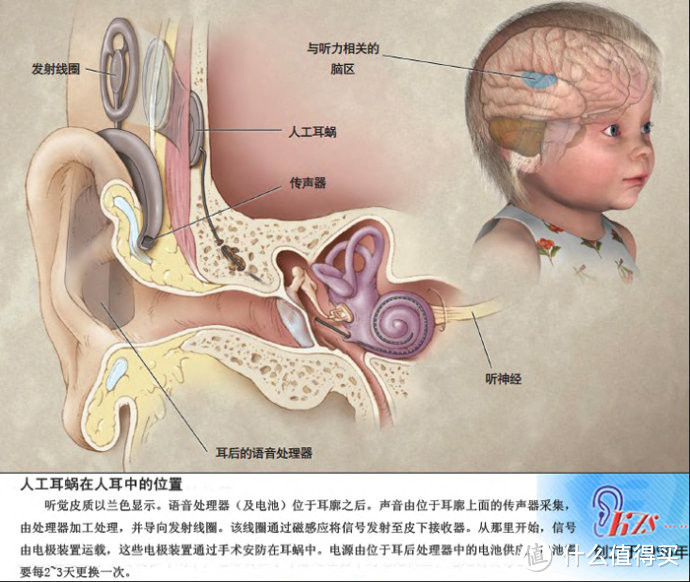 人工耳蜗