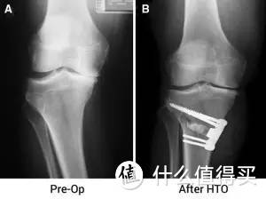 如何矫正X型腿？