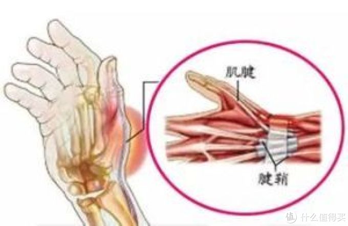 大保健之腱鞘炎的克星 医药箱 什么值得买