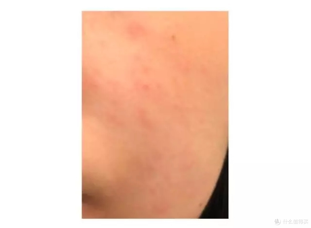 又到一年换季皮肤躁动时!如何和毛孔黄气说拜拜!