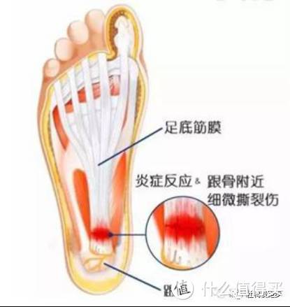 我是如何搞定足底筋膜炎的