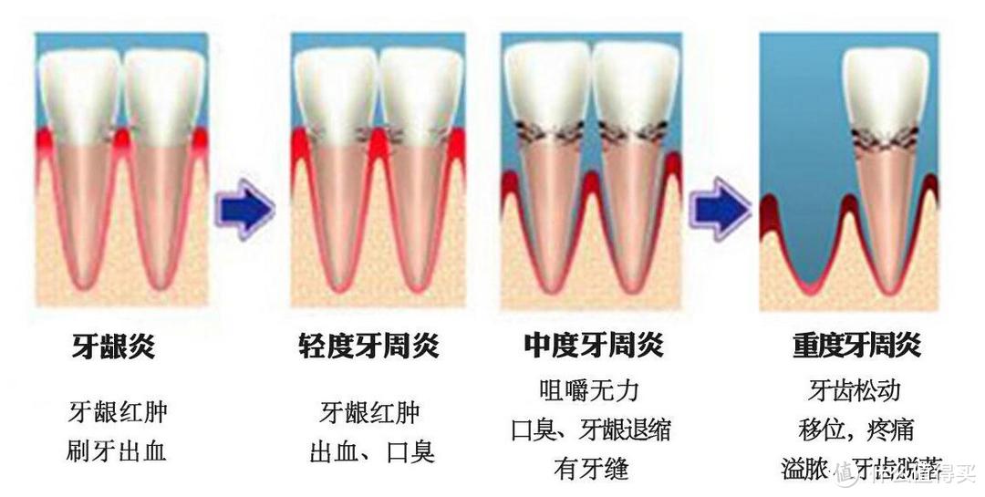 牙科博士告诉你 —冲牙器真的能去除牙菌斑吗？