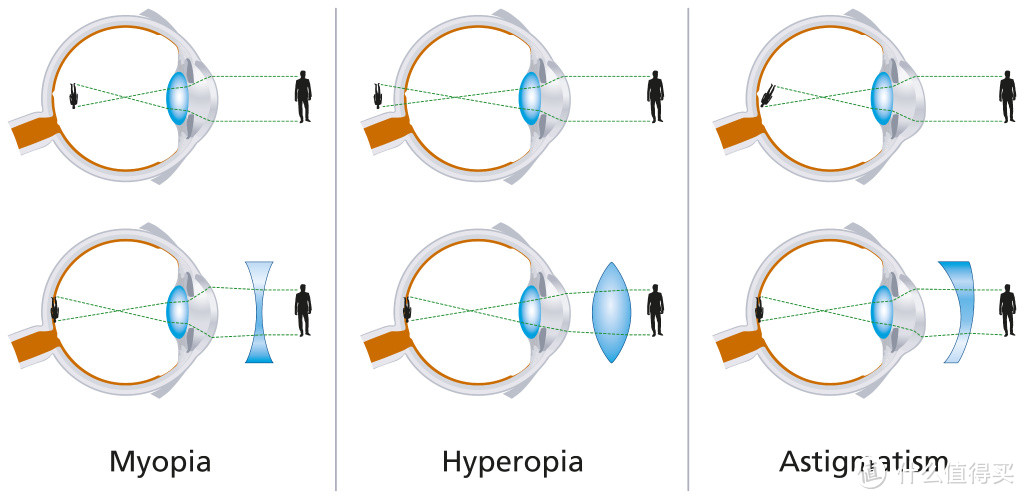 屈光不正表现形式：近视（左），远视（中），散光（右）