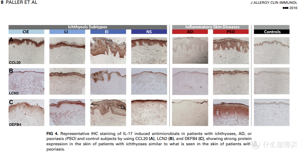 最左边的CIE应该就是最轻微的，一般叫IV，Ichthyosis Vulgaris