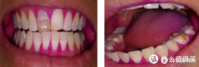 牙菌斑指示剂实测！贝医生S7&飞利浦&欧乐B哪个刷的最干净