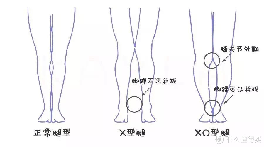 这次就要跟XO型腿说拜拜