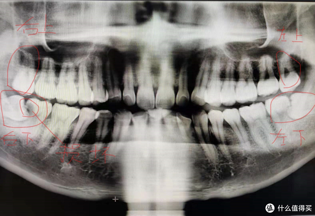 你的智齿需要拔吗 19年末拔牙大记 牙齿矫正 什么值得买