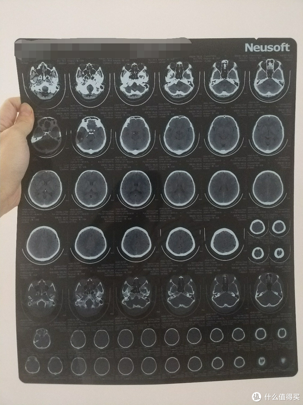 脑CT真实图片