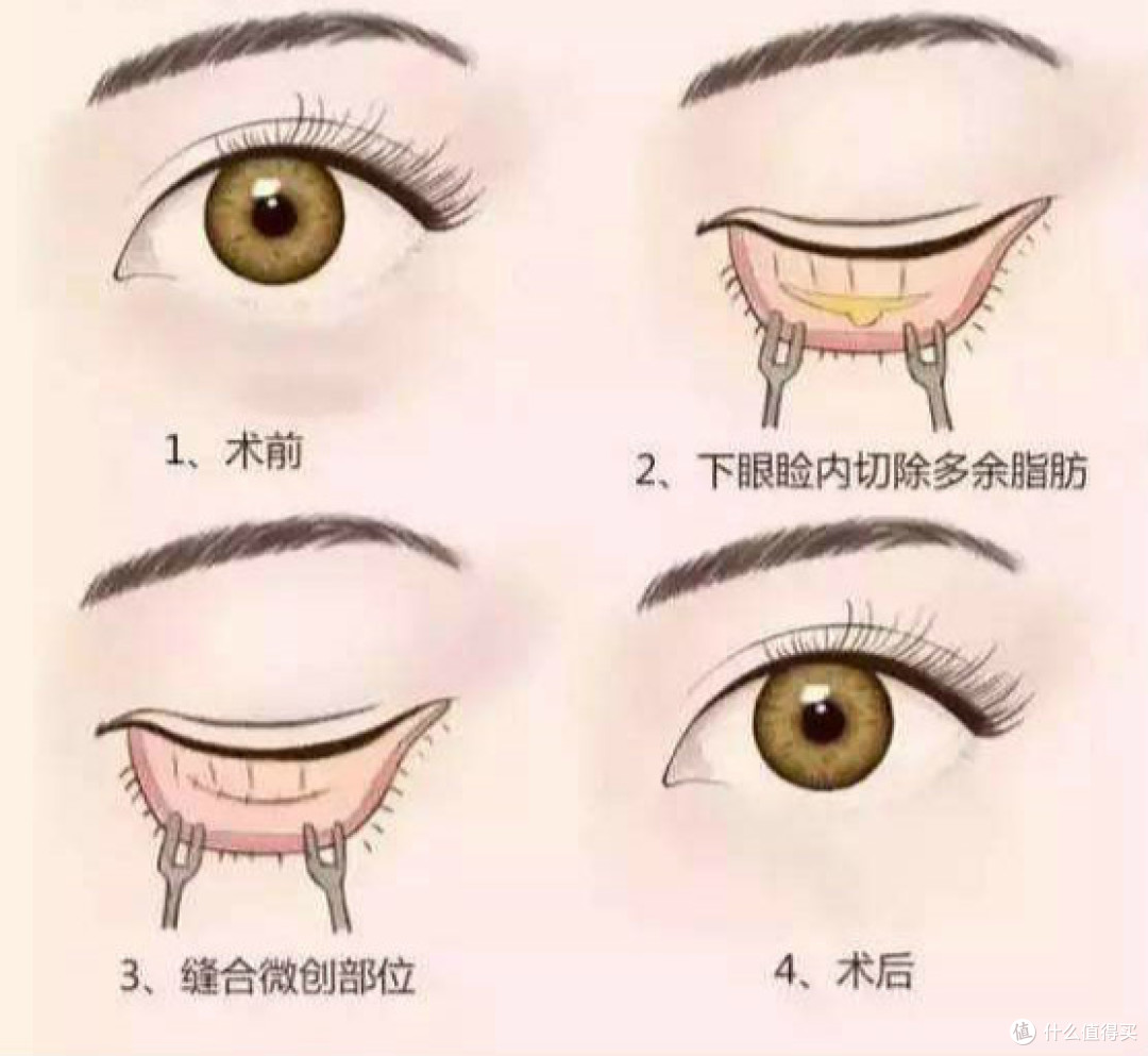 眼袋太大了,颜值被拉低?只需这几步,就能和眼袋说“拜拜”!