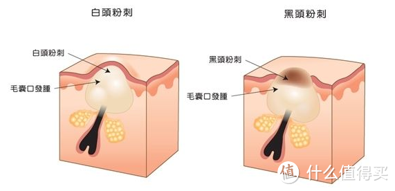 皮肤杀手——粉刺，怎么破？