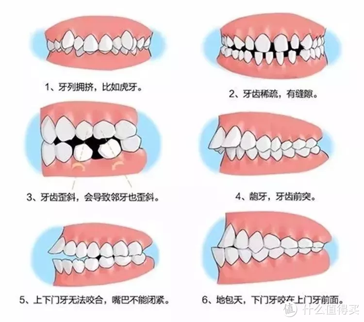 7成以上的孩子有不同程度的错颌畸形  18个儿童正畸问题详解，别错过牙齿矫正黄金期