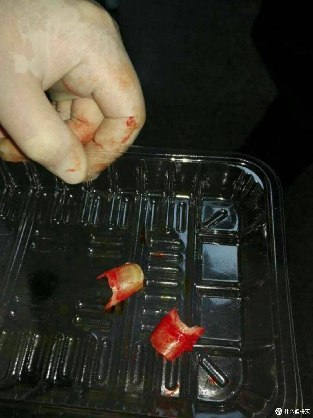 一次痛彻心扉刻骨铭心的,甲沟炎治愈经历!