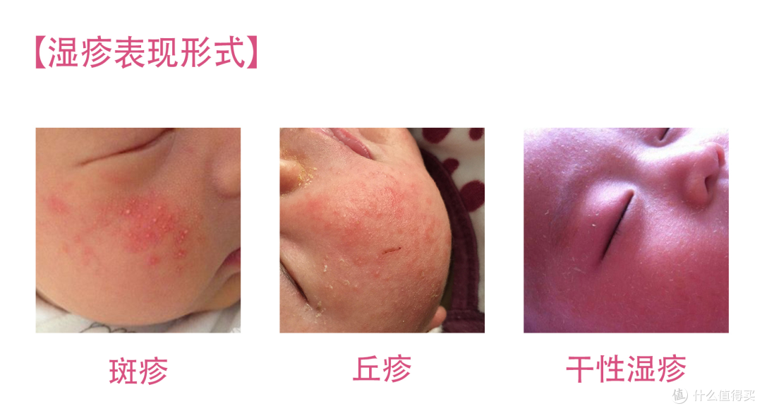 湿疹 热疹 荨麻疹 猩红热 手足口 儿童皮肤常见9种炎症解说 妇婴健康 什么值得买