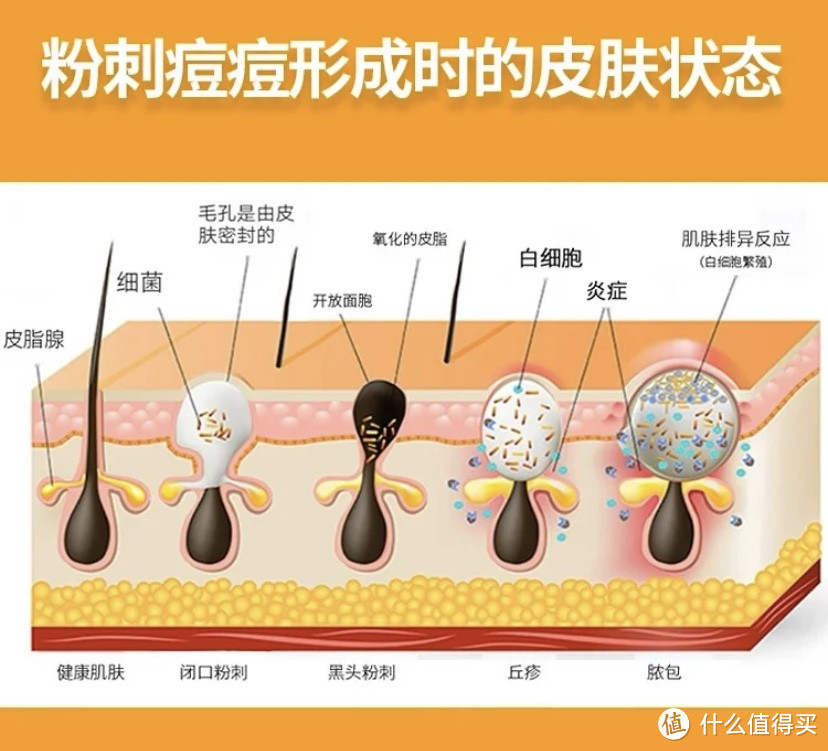 拯救油皮痘肌，男女通用的祛痘秘籍——买的多不如懂得多