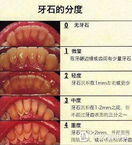 我经历过的牙科治疗：龋齿、拔牙、立事牙、根管治疗、烤瓷牙、儿童牙齿损伤