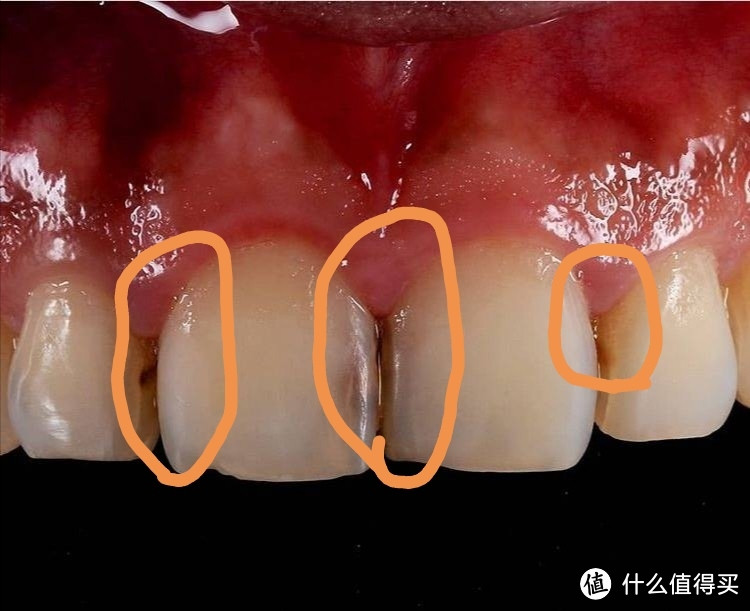 牙齿口腔篇一 人生第一次洗牙之后 接着就是历时近一年的看牙经历 口腔管理 什么值得买