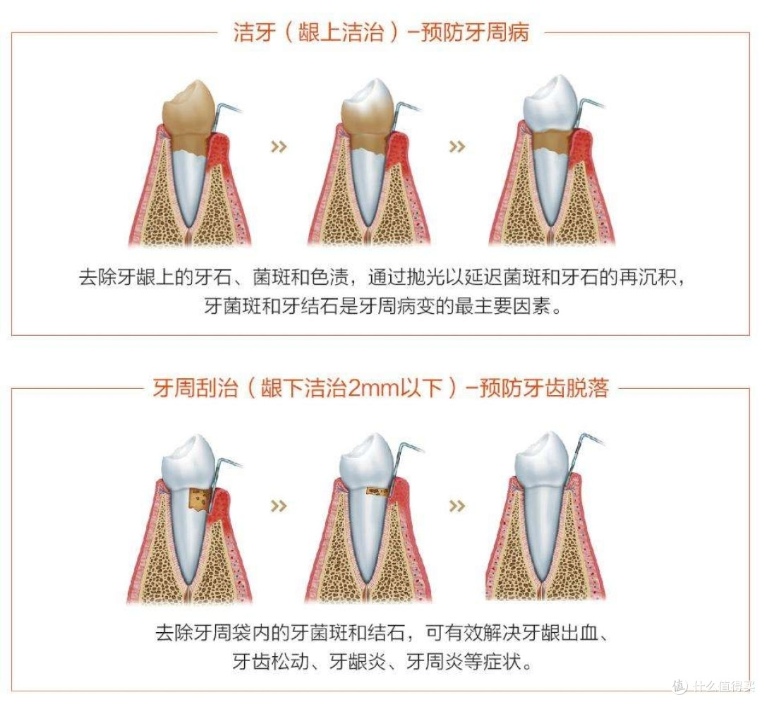 龈下刮治真不疼!亲历经验:牙周病克星不可怕,很温柔。