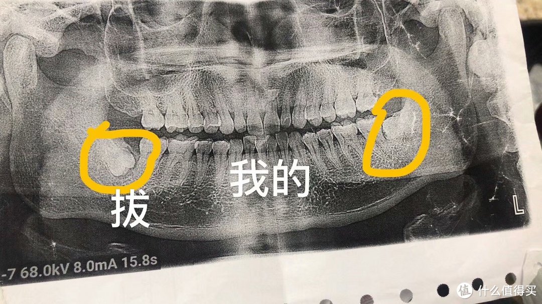 2020720右下低位阻生智齒拔除經歷