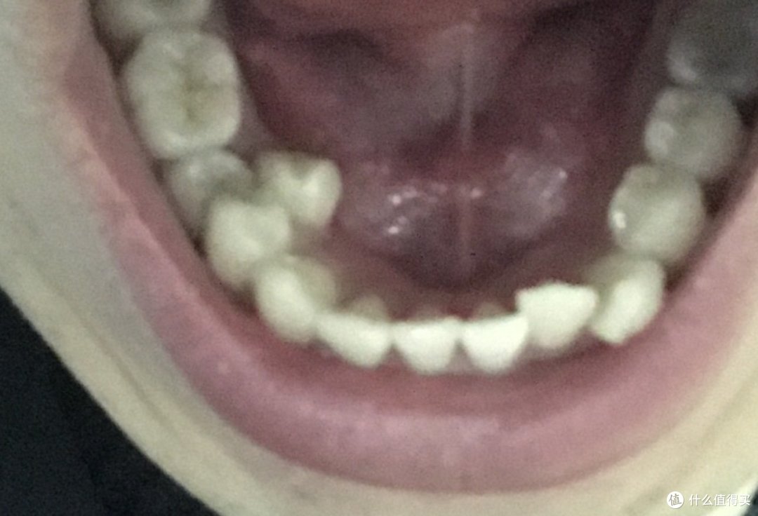 述说十年来在牙齿上的坎坷经历 拔智齿 拔多生齿 根管治疗 牙冠 洗牙 我知道的全都告诉你 口腔健康 什么值得买