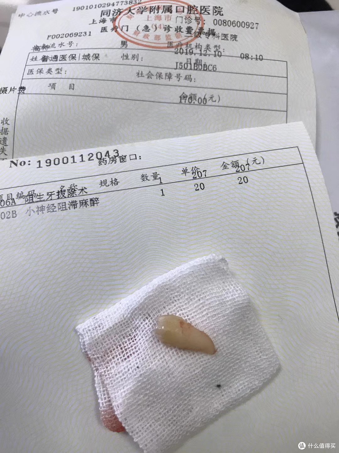 述说十年来在牙齿上的坎坷经历——拔智齿/拔多生齿/根管治疗/牙冠/洗牙,我知道的全都告诉你