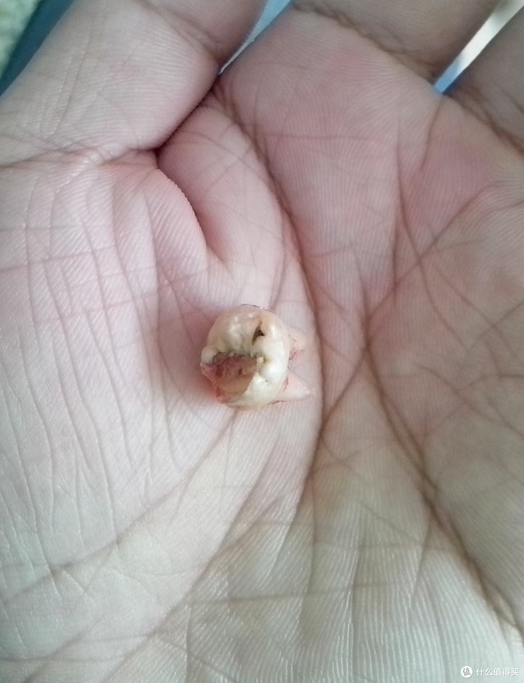 述说十年来在牙齿上的坎坷经历——拔智齿/拔多生齿/根管治疗/牙冠/洗牙,我知道的全都告诉你