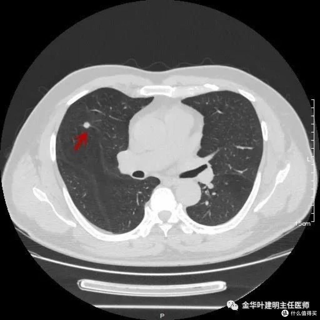 结节不等于肺癌,查出了肺结节,还能买保险么?