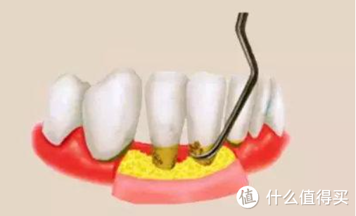 龈下刮治示意图