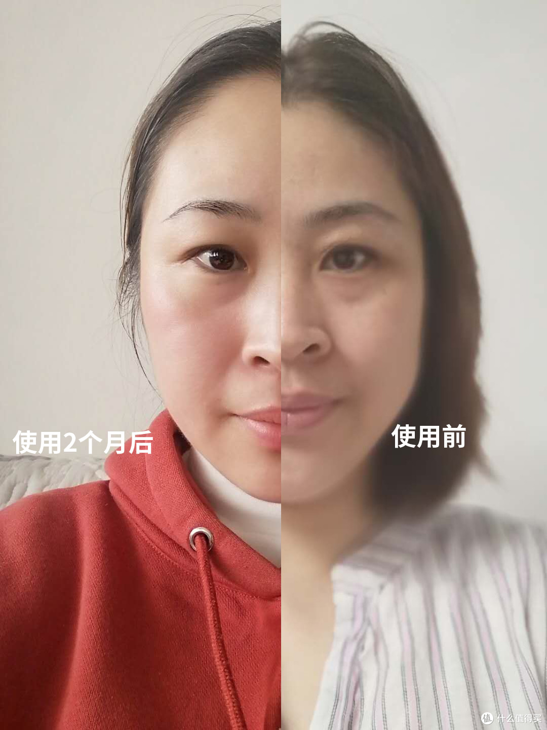Tripollar stop X开箱体验:使用2月后效果很满意