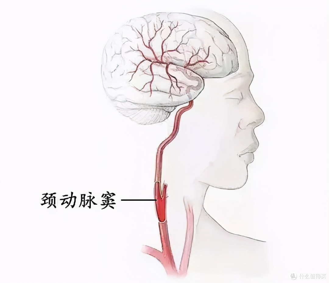 如果脖圈戴得太紧,可能会压迫到气管或颈动脉窦,前者很容易造成窒息