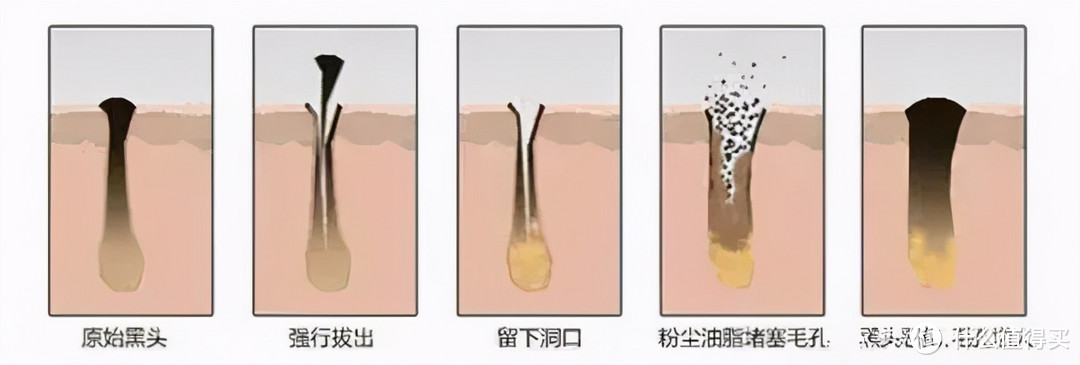 20倍放大功能的可视化黑头仪，能吸出成“吨”的油脂