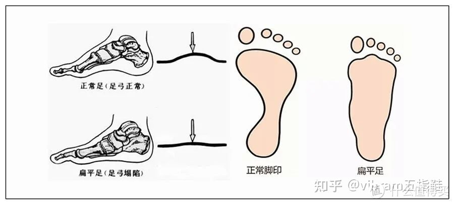 【跑者训练营】平足，要不要穿鞋？