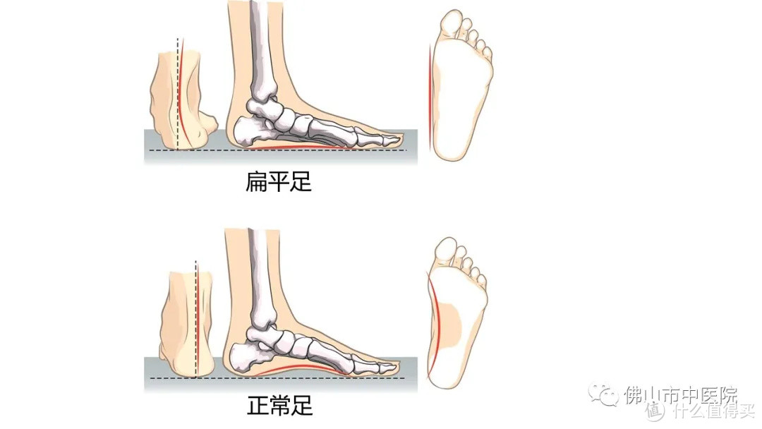 緩解扁平足疼痛還得矯正鞋來幫忙