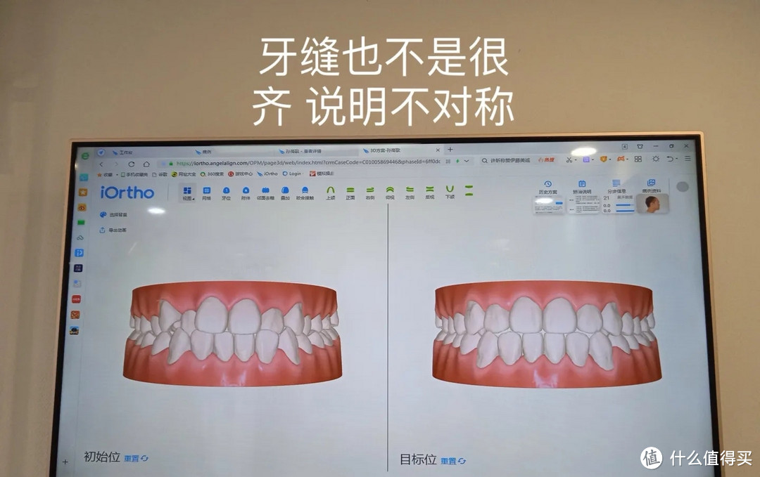 隐形牙套矫正记录（一）口腔扫描体验
