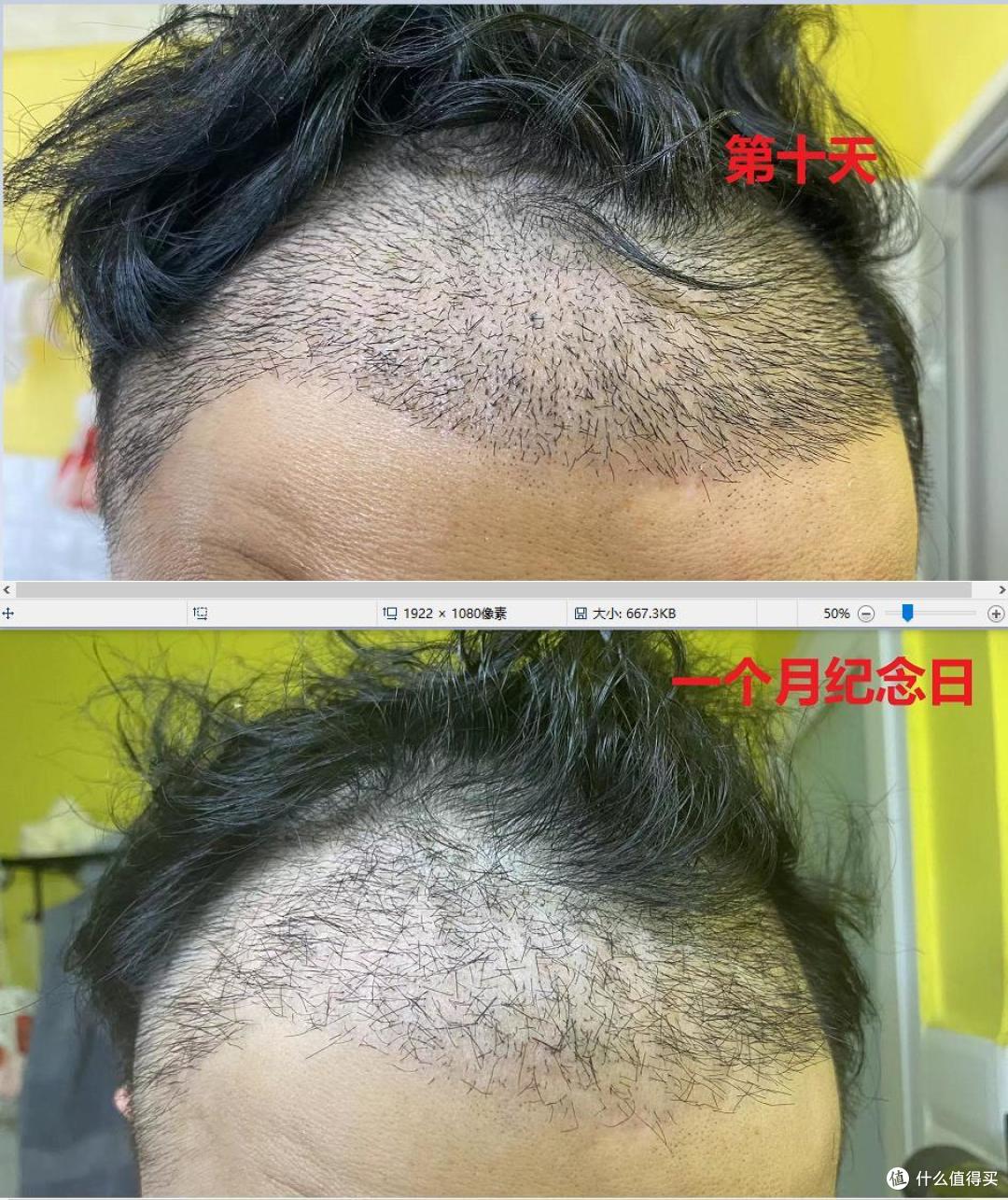 (植发后第一个月)