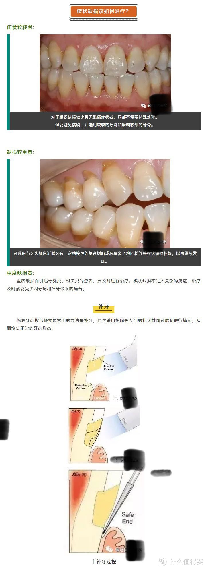 M奥口腔牙齿检查经历(牙齿锲形缺损补牙....)