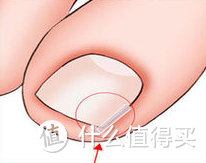 最先保护脚趾头，个人挑选购买嵌甲矫正器的建议