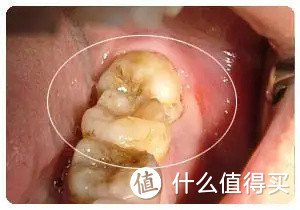 以过来人的身份告诉你：超过30岁以上尽量不要拔牙