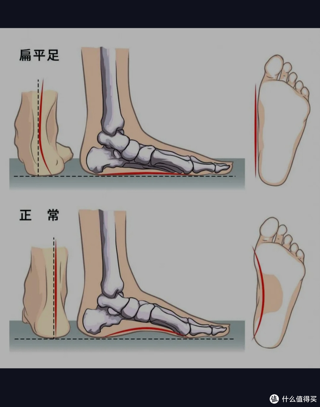 扁平足和正常足照片图片